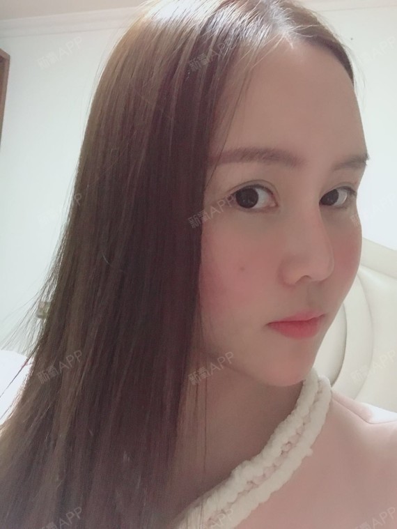 假体眉弓第五篇.