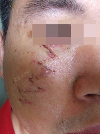 外伤后疤痕导致下眼睑下翻已经23年到处求治疗无果,_圈子-新氧美容