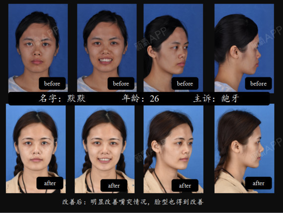 如果你是骨性的龅牙,那么你的牙齿颌上颌骨以及鼻子周围都是向前鼓的