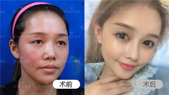 为了一张更美的面孔女生们愿意付出什么