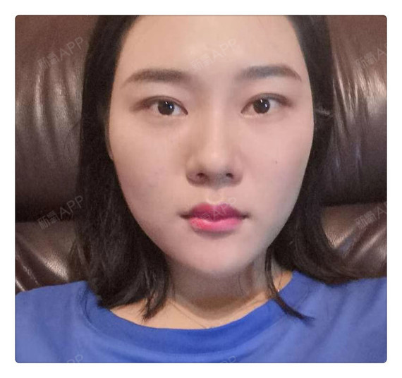 其实我本身就是属于骨架大的人,脸也宽,有咬肌的时候_圈子-新氧美容