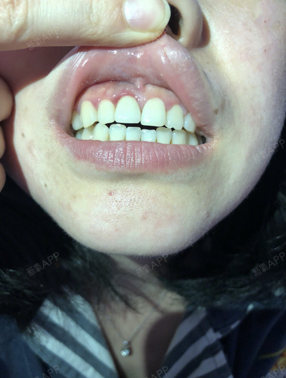 傻彤子种植牙第0天美丽日记-新氧美容整形