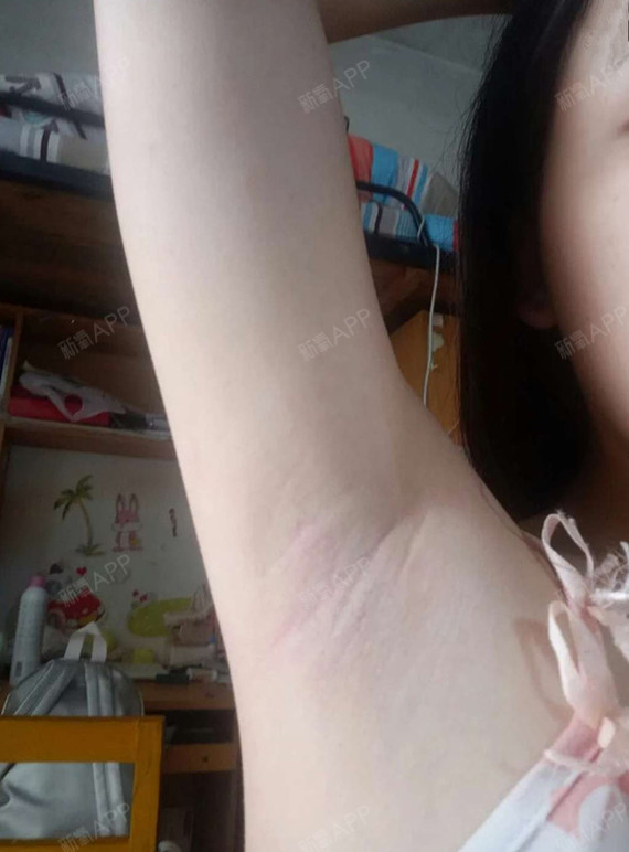 初高中欧冠就开始长腋毛了,一直不敢脱毛怕长也不敢自_圈子-新氧美容