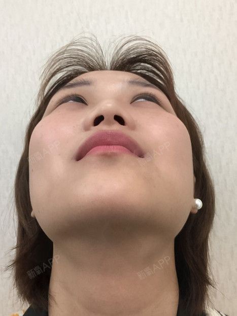 手术缩鼻翼好不好_效果图_t维若t手术缩鼻翼术后第2天_新氧美容整形