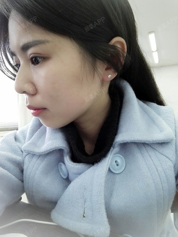 瘦脸针打几次,效果可以保持永久呢?微整达人亲