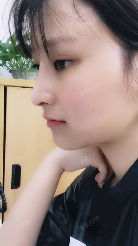手术缩鼻翼好不好_效果图_t维若t手术缩鼻翼术后第58天_新氧美容整形