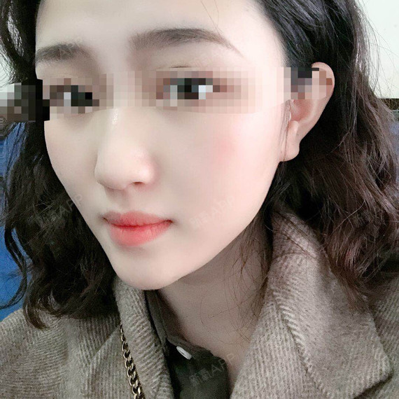 现在是打完瘦脸针半个月了,有瘦一点,但还是感觉没有_圈子-新氧美容