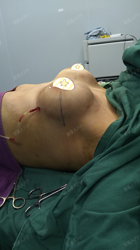 别在我赖上伱的温暖后离开乳房下垂矫正第1天美丽日记