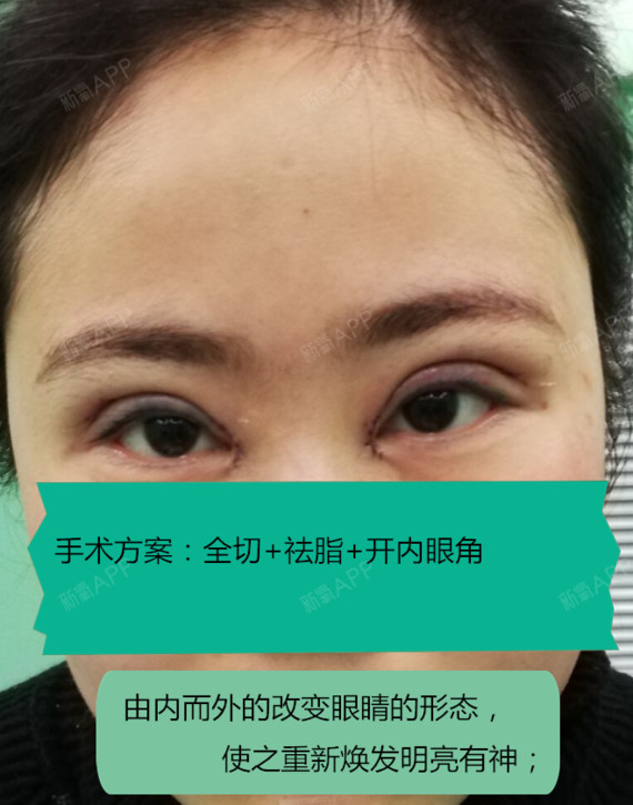 信阳东方艺双眼皮案例分享:眼部基础情况:左眼
