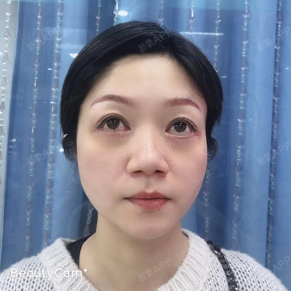 外切去眼袋好不好_效果图_氧气z9hn3外切去眼袋术后第7天_新氧美容