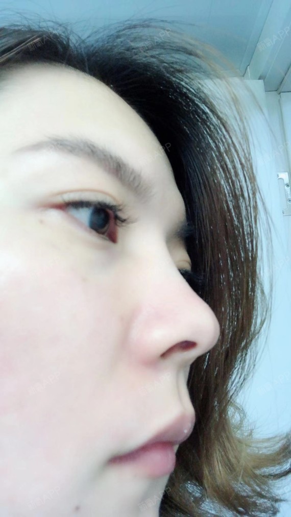 【玻尿酸隆鼻】因为我的鼻梁山根只是稍微的低一些,所_圈子-新氧美容