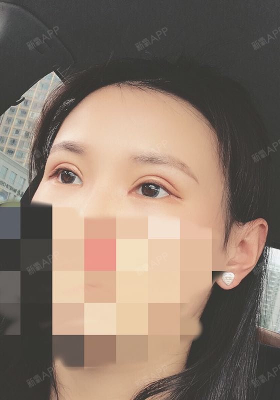 【术后15天】谨遵医嘱,小心地呵护着我的双眼皮,消_圈子-新氧美容整形