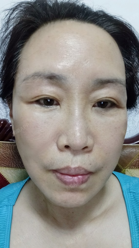 氧气zf617拉皮手术提升第39天美丽日记