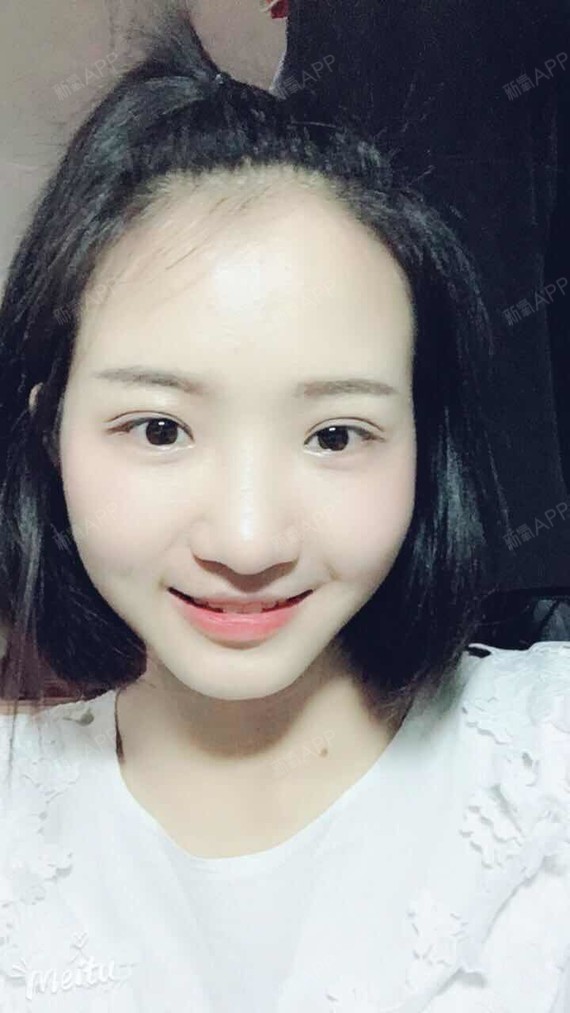 长沙美臣铂宫不开刀双眼皮开眼角