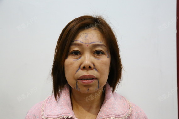 北京拉皮手术提升好不好_效果图_氧气zf613拉皮手术提升术后第0天