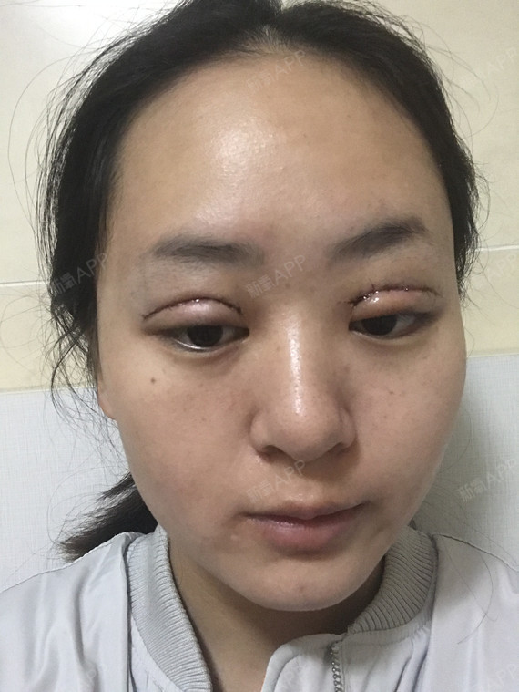 切开双眼皮好不好_效果图_萌神会发光切开双眼皮术后第1天_新氧美容