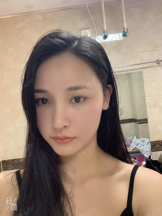 做完鼻子术后23天的我美出了新高度做了鼻子之后自