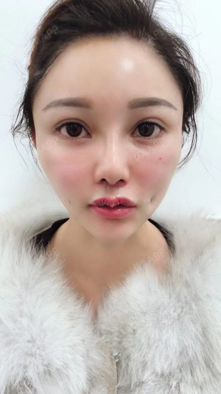 上海m唇手术好不好_效果图_氧气zh00zm唇手术术后第0天_新氧美容整形