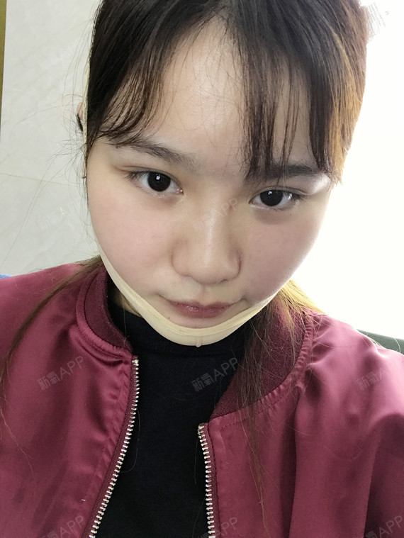 一碗叉烧面部吸脂第3天美丽日记-新氧美容整形