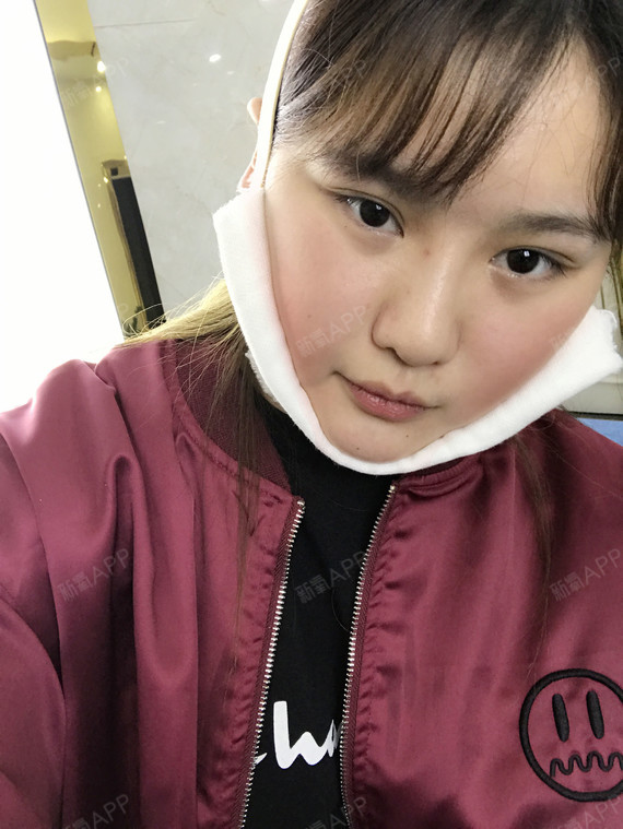 一碗叉烧面部吸脂第3天美丽日记-新氧美容整形