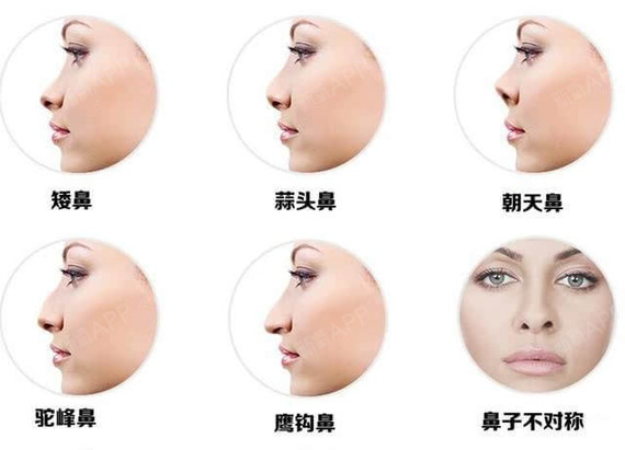 5.标准鼻小柱 鼻小柱与上唇人中呈90度.