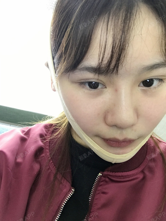 一碗叉烧面部吸脂第3天美丽日记-新氧美容整形