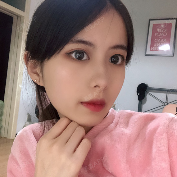 可以回家睡觉激光祛斑第30天美丽日记-新氧美