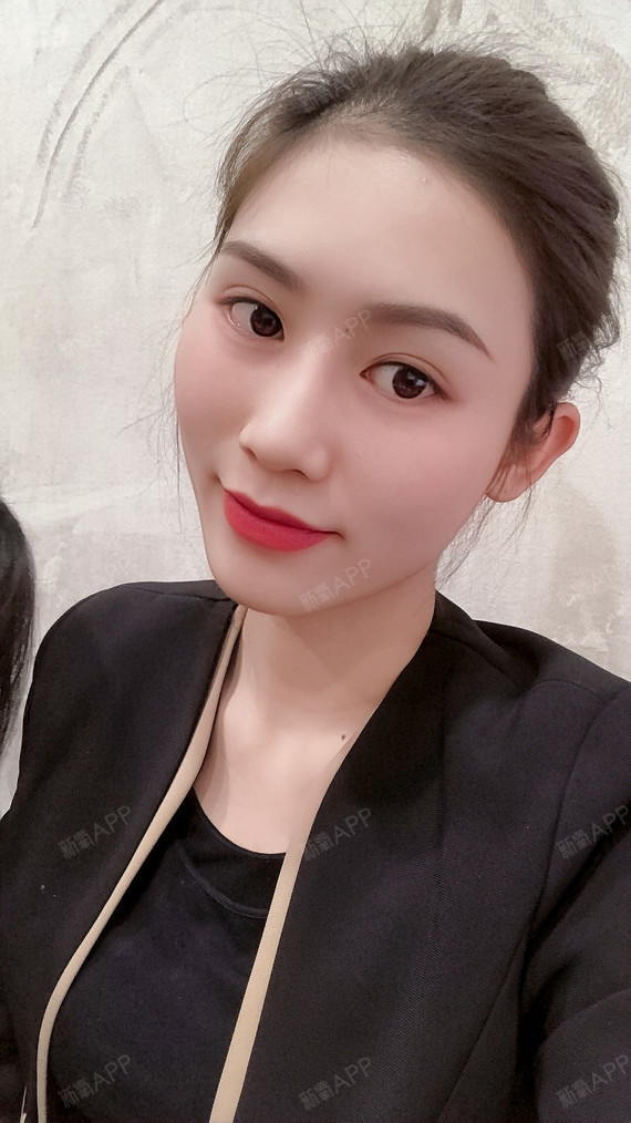 玻尿酸全脸填充好不好_效果图_慧慧玲玻尿酸全脸填充术后第2天_新氧