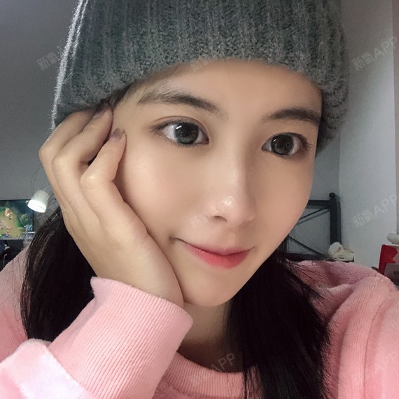 可以回家睡觉激光祛斑第30天美丽日记-新氧美