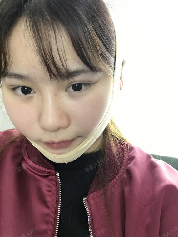 一碗叉烧面部吸脂第3天美丽日记-新氧美容整形