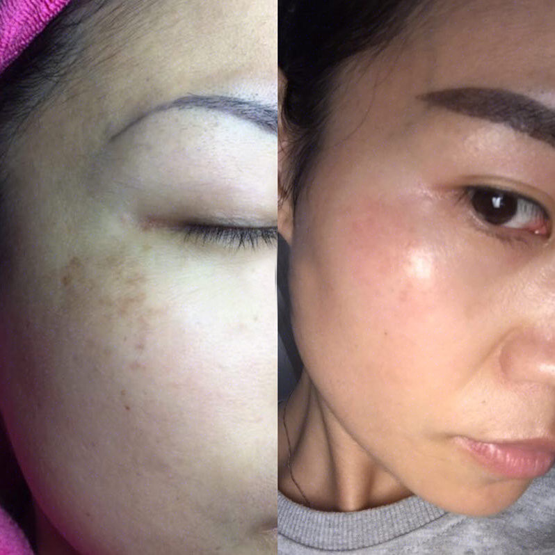 医美科普|正确认识容易混淆的雀斑和雀斑样痣区分治疗!