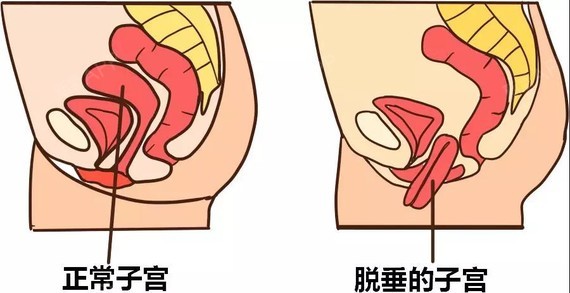 三,阴道松弛导致阴道干涩,性交痛和出血:阴道松弛后,阴道壁外翻不能