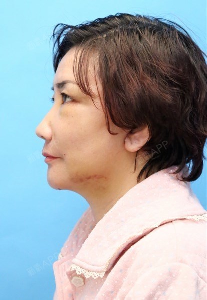 拉皮手术提升好不好_效果图_女人的浪漫之旅拉皮手术提升术后第6天