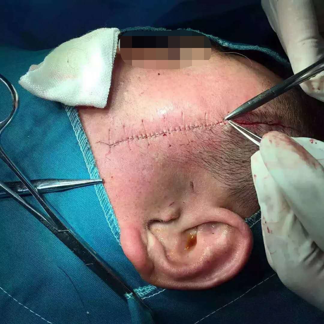 一个伤口粗糙的缝10针和【精细的缝40针】,你觉得_圈子-新氧美容整形