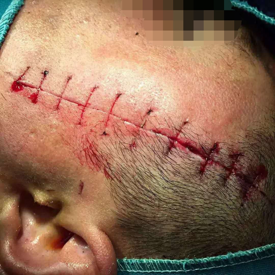 一个伤口粗糙的缝10针和【精细的缝40针】,你觉得哪个更好?