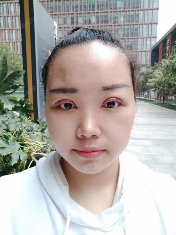 术后第一天,双眼皮加开眼角,眼睛稍微有点肿胀,但是_圈子-新氧美容