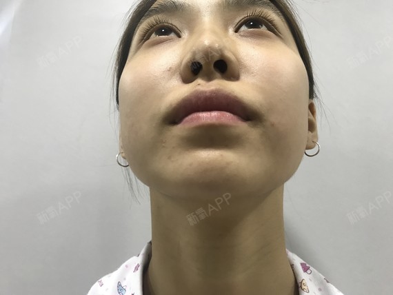 耳软骨复合隆鼻