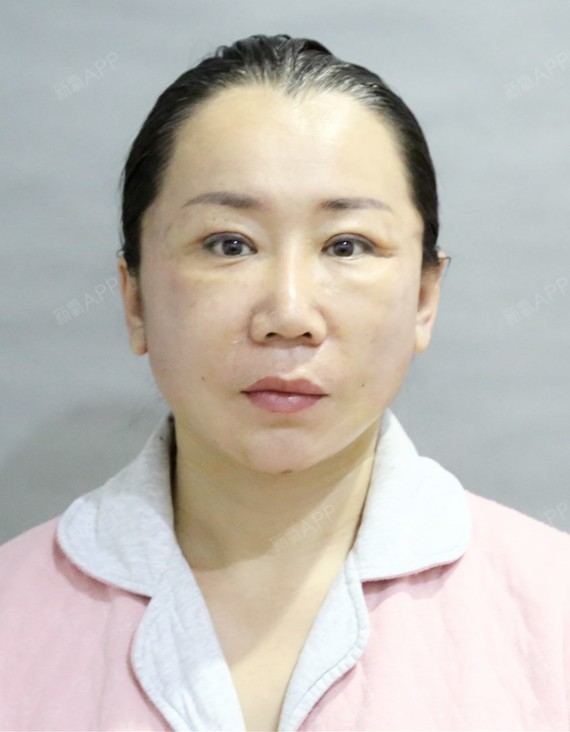 氧气zf616拉皮手术提升第5天美丽日记