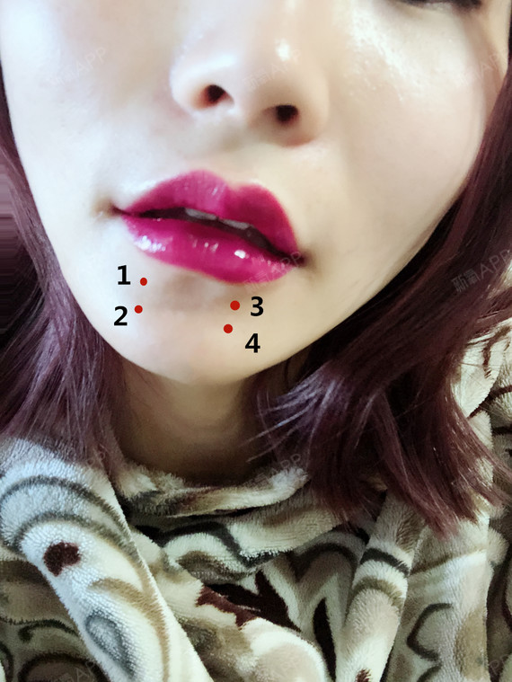 项目玻尿酸m唇嘴角上扬肉毒素注射