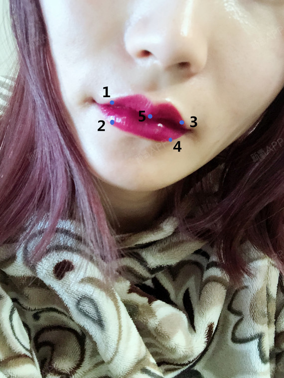 项目玻尿酸m唇嘴角上扬肉毒素注射