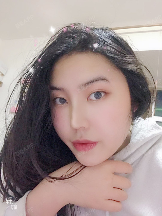 尹丽尽Anna肉毒素瘦脸第22天美丽日记-新氧美