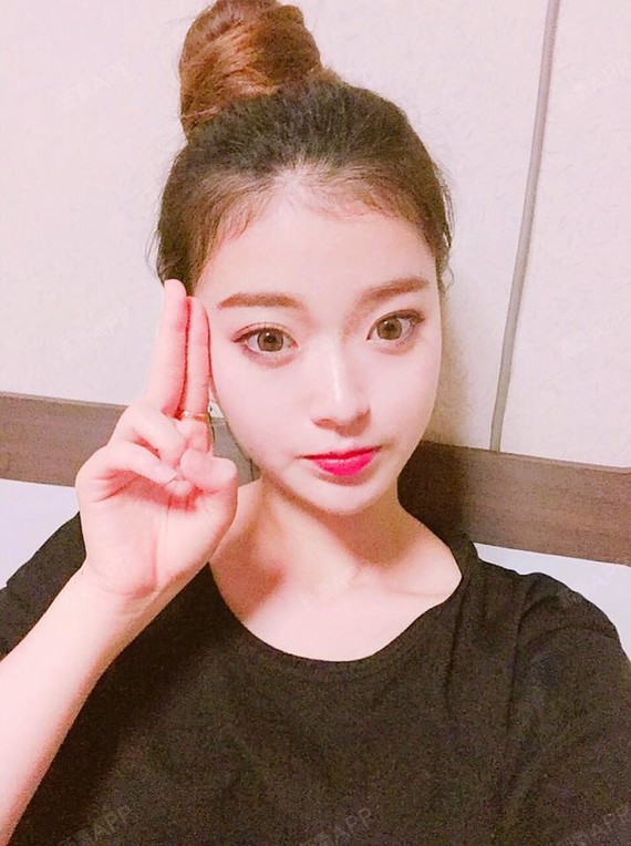 【苏州美贝尔—芭比小翘鼻】隆鼻术后26天了,鼻部形_圈子-新氧美容