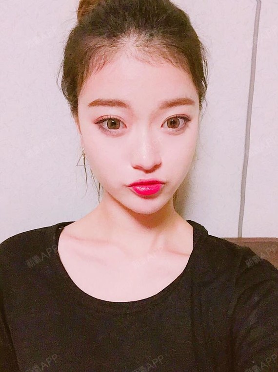 【苏州美贝尔—芭比小翘鼻】隆鼻术后26天了,鼻部形_圈子-新氧美容