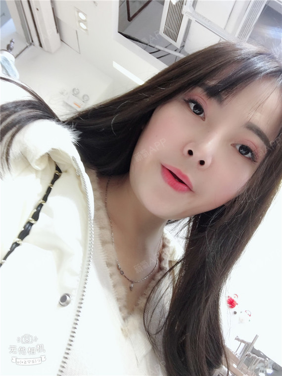 福州膨体隆鼻好不好_效果图_简单小仙女膨体隆鼻术后第70天_新氧美容