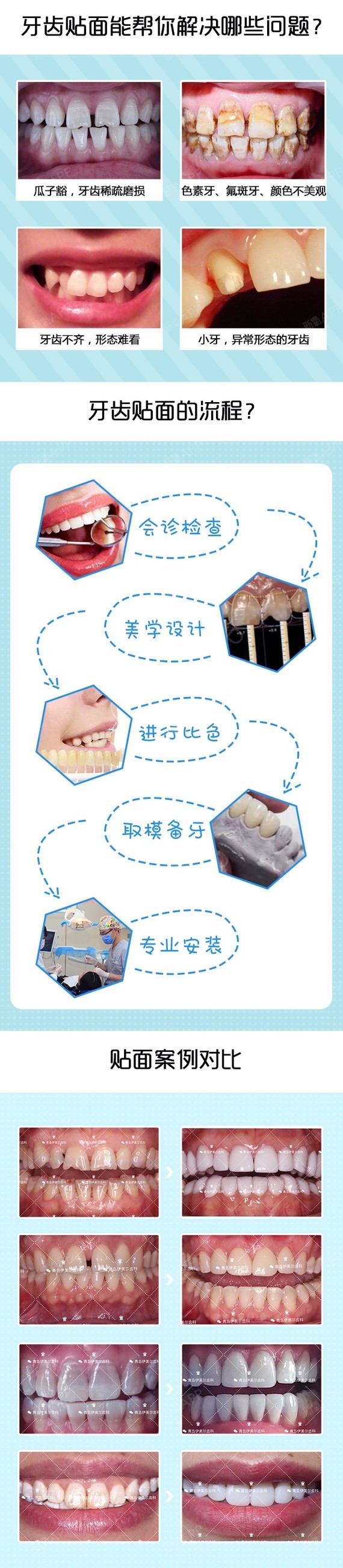 【瓷贴面】全瓷牙齿贴面 稳固耐用美白 不着色 不伤牙 超高耐磨性
