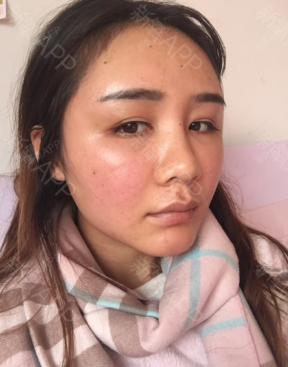 脸依然肿,连带着眼睛都小了一圈,整个脸部消肿不是很_圈子-新氧美容