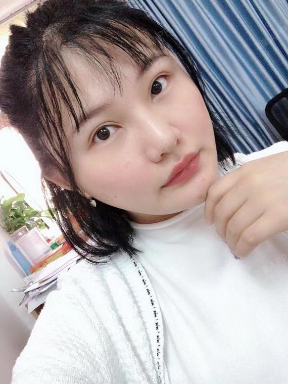 沸沸扬扬za面部吸脂第31天美丽日记-新氧美容