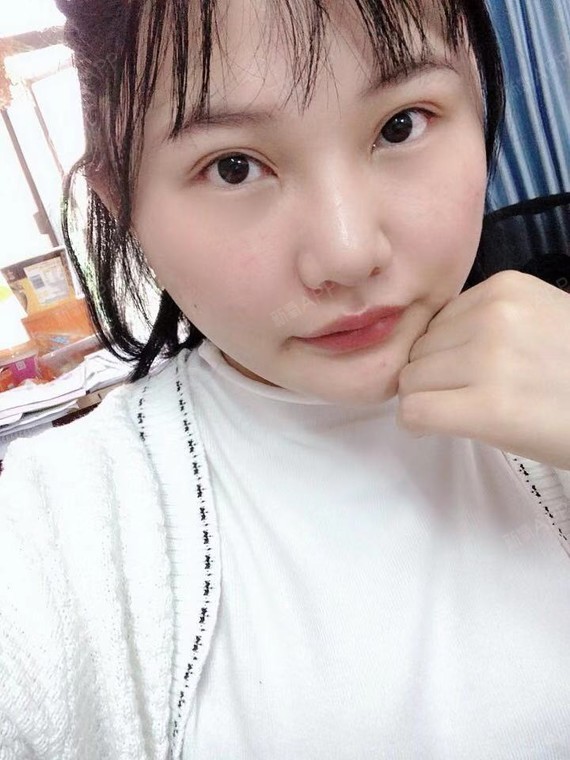 沸沸扬扬za面部吸脂第31天美丽日记-新氧美容