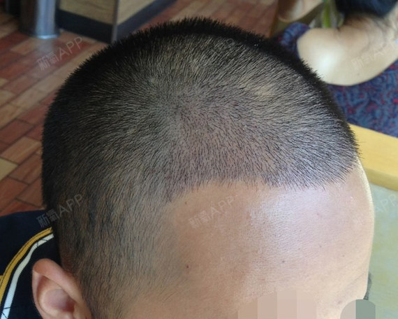 植完发己经8天了,还确实长出了许多头发的,能有这样_圈子-新氧美容