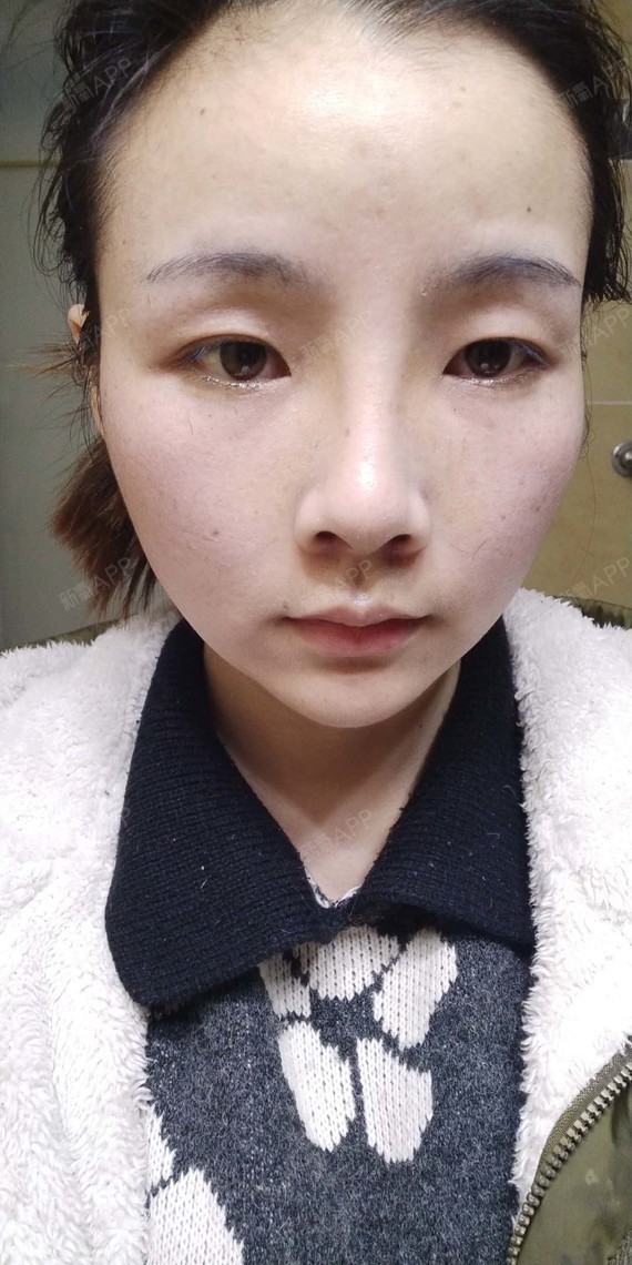 鼻部多项术后第10天